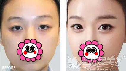 秦皇岛靠谱的整形美容医院排行榜来啦 双眼皮选这5家准没错