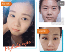眼部美容价格 广州美莱眼部美容医疗 眼部美容医疗哪里好 美莱整形医院品牌连锁