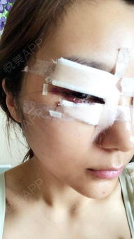 叶美人医疗美容医院眼部综合陪朋友来手术,自己也是面...双眼皮 悦美整形