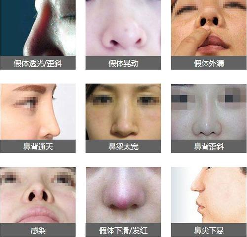 隆鼻失败有多可怕