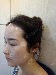 哈喽宝...面部填充 悦美整形