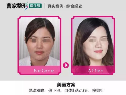 新拿到一份衡阳曹家整形医疗美容医院2018年价格表以及自体脂肪整形真人案例