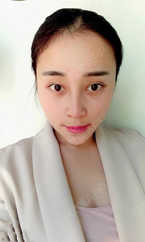 现在做完手术一个...鼻综合 悦美整形