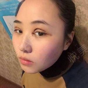 标准的单眼皮小眼睛星人,除去眼睛和眉毛不看,觉得自...眼综合整形 悦美整形