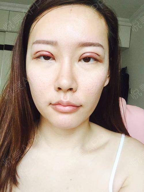 做手术之前大小眼什么的就不想多说了,手术在百达丽做...眼整形失败修复 悦美整形